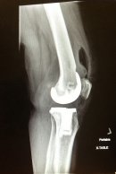 kolano - zdjęcie rentgenowskie